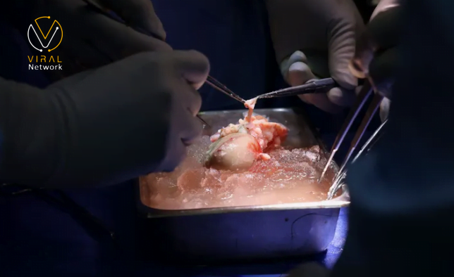 العملية الأولى لزراعة كلية من خنزير إلى إنسان