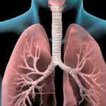 كيفية التعامل مع التهاب الشعب الهوائية الحاد
