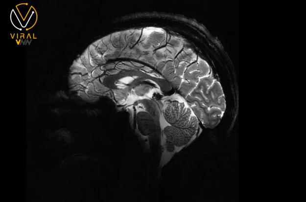تقنية تصوير الدماغ بدقة فائقة باستخدام أحدث أجهزة الرنين المغناطيسي