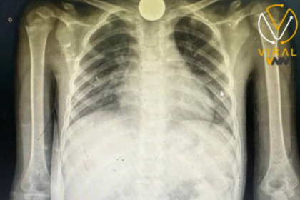 طبيب عماني يروي ما يأكله الأطفال في غزة بسبب الجوع