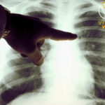 تأثير الأنظمة الغذائية قليلة الدهون على خطر الإصابة بسرطان الرئة