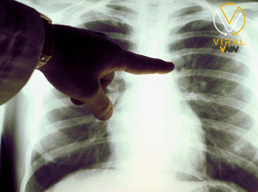 تأثير الأنظمة الغذائية قليلة الدهون على خطر الإصابة بسرطان الرئة