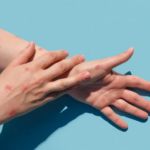 أوروبا تعلن حالة الطوارئ بسبب تفشي جدري القردة