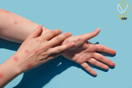 أوروبا تعلن حالة الطوارئ بسبب تفشي جدري القردة