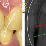 الأسباب الشائعة وراء الالتهابات الحادة في اللثة