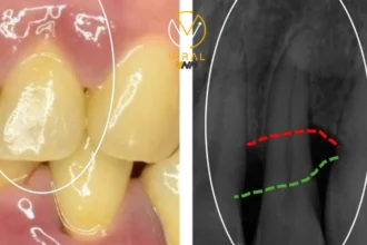 الأسباب الشائعة وراء الالتهابات الحادة في اللثة