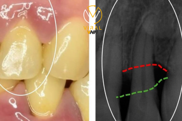 الأسباب الشائعة وراء الالتهابات الحادة في اللثة