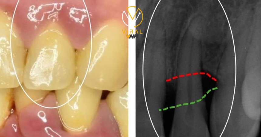 الأسباب الشائعة وراء الالتهابات الحادة في اللثة