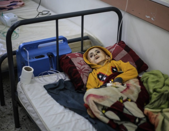 استشهاد طفلة نتيجة الجوع وسوء التغذية في غزة
